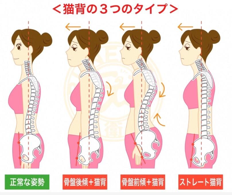 猫背姿勢のイメージ図