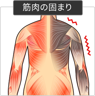 筋肉の固まりイメージ図
