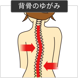 背骨の歪みイメージ図